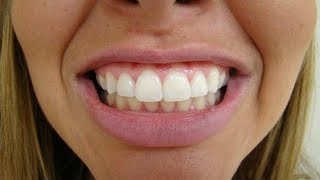 Todas As Próteses Dentárias Flexíveis São de Silicone Removível [upl. by Elpmet81]