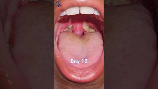 Childs Tonsillectomy Time Lapse Day 1  20 tonsils surgeryrecovery timelapse [upl. by Carey]