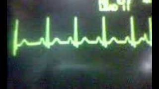 ECG Video Ectopics  Atrial [upl. by Ahseat]