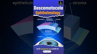 Descemetocele  Ophthalmology  complete Guideline Descemetocele ophthalmology testpaperlive [upl. by Adnowal533]