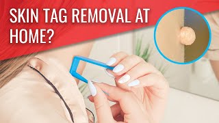 How TagBand removed my SKIN TAG [upl. by Eerol553]