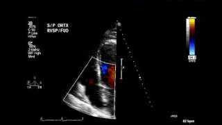 Eccentric tricuspid regurgitation jet suggests flail leaflet [upl. by Cristy]