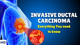 Invasive Ductal Carcinoma Breast Cancer – Causes Signs and Symptoms Diagnosis amp Treatment [upl. by Harvard96]