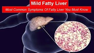 Mild Fatty Liver Most Common Symptoms Of Fatty Liver You Must Know [upl. by Bigner]