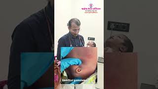 Umbilical Granuloma information अम्बिलिकल ग्रॅन्युलोमा माहीती [upl. by Adriell308]