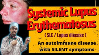 quotUnderstanding SLE Lupus Treatment Options Lupus Nephritis and Lupus Blood Disorders and NMOSDquot [upl. by Rundgren]