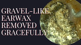 Gravellike Earwax Removed Gracefully [upl. by Sekofski]