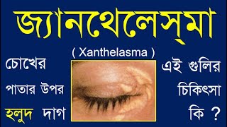 XanthelasmaSymptoms and treatment xanthelasma xanthelasmTreatment xanthelasmaEye doctorSight [upl. by Attenev]