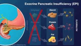 Exocrine Pancreatic Insufficiency [upl. by Llehsam]