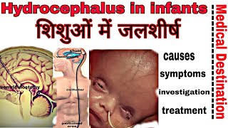 Hydrocephalus in infantscausessymptomtreatment and prevention in hindi  Medical destination [upl. by Accber]