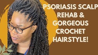 Ultimate Psoriasis Scalp Treatment amp Stunning Prelooped Crochet Hairstyle Tutorial [upl. by Gerdy]