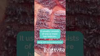 What Is A Hair Graft  Longevita [upl. by Anaitsirc965]