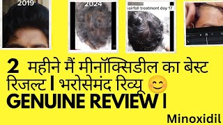 minoxidil result  Minoxidil hair growth tips minoxidil mor f 5  result  Hair growth  Balayantra [upl. by Aivat340]