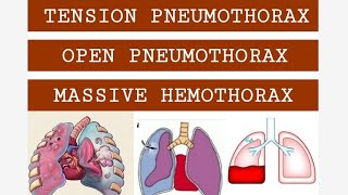 TENSION PNEUMOTHORAX OPEN PNEUMOTHORAX amp MASSIVE HEMOTHORAX [upl. by Moses]