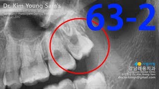 upper wisdom tooth extraction with new Hufriedy forceps [upl. by Adolpho]