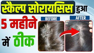 Scalp Psoriasis story  Scalp psoriasis treatment  स्कैल्प सोरायसिस हुआ 5 महीने में 100 ठीक [upl. by Joni]