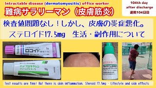 【指定難病】【皮膚筋炎】ステロイド175mg服用、皮膚の炎症増加！Taking 175mg of steroids skin inflammation increased [upl. by Joses]