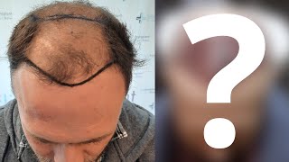 Michaels Hair Transplant Story  Before During  After His Transplant in Turkey [upl. by Asiat802]