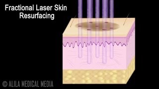 Traditional versus Fractional Laser Skin Resurfacing Procedure Animation [upl. by Nyvek32]