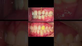 هدایت رویشی نیش های نهفته فک بالا  Guided eruption of maxillary impacted canines [upl. by Ortiz]