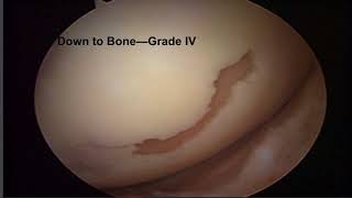 Knee Chondromalcia and Its Treatment [upl. by Belldas]