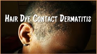 Severe Hair Dye Contact Dermatitis [upl. by Adiv]