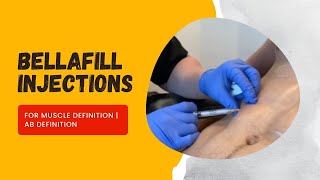 Bellafill Injections for Muscle Definition  Ab Definition  West Hollywood CA  Dr Jason Emer [upl. by Yerahcaz211]