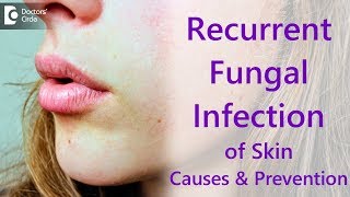 Why do i get recurrent fungal skin infections  Dr Amee Daxini [upl. by Iggam930]