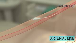 Radial arterial line placement patient explanation [upl. by Schriever569]