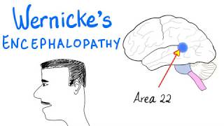 Wernickes Aphasia Fluent Aphasia  Neurology [upl. by Llerdnod310]