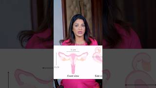 क्या Bicornuate uterus में Pregnancy हो सकती है sonaamedihub drsonalparihar gynaecologist [upl. by Nalo]