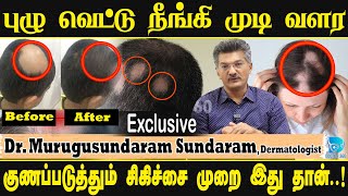 🔥இனி முடி கொட்டாது வளரும்🔥  Treatment for Alopecia Areata  Puluvettu doctor360 alopecia [upl. by Ahsienar]