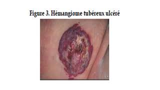 DERMATOLOGIE  cours 4  Angiome du nourrisson [upl. by Aleahc]