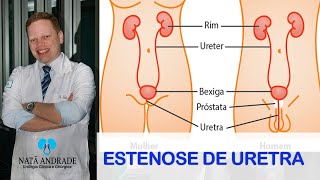 Estenose de Uretra [upl. by Phalan]