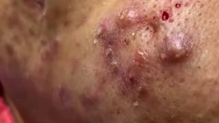 How to remove blackheads and whiteheads on face at homeHow to remove acne29 [upl. by Hinkel]