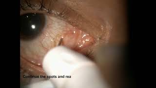 Treatment of Conjunctival Cyst Ablation using ALTP  Supplementary video ID 265032 [upl. by Oterol]