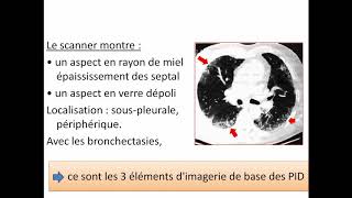 Cas clinique ECN en pneumologie  Résumé de PNEUMOPATHIES INFILTRATIVES DIFFUSES PID [upl. by Hirasuna]