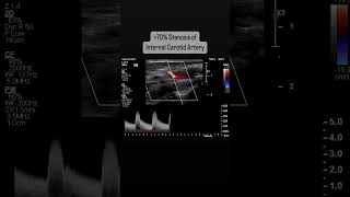 Internal Carotid Artery Stenosis over 70 stroke ultrasound doppler radiology diagnosis [upl. by China]