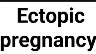 Ectopic pregnancy [upl. by Meehar]