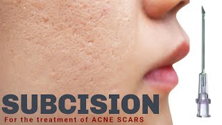 Subcision for Acne Scars  Advanced Dermatology amp Laser Institute of Seattle [upl. by Doowrehs232]