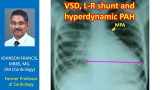 VSD LR shunt and hyperdynamic PAH [upl. by Oralla]