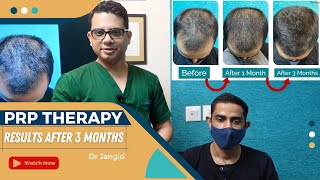 PRP Therapy Results After 3 Months  Hair Transplant by Experts in Delhi  Dr Jangid [upl. by Silra]