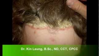 Dr Kin Leung Naturopathic Case Review Patient with Psoriasis Vulgaris plaque silver scales on scalp [upl. by Araminta]