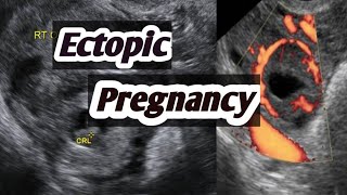 sonography of Ectopic pregnancyEctopic pregnancy in early scanUltrasound of Ectopic please [upl. by Ydoow]