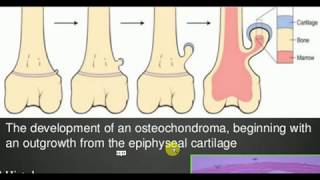 ORTHOPEDICS LECTURES  Tumors  OSTEOCHONDROMA [upl. by Dayna]