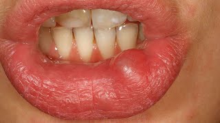 Traumatic Mucous Cyst  Oral Mucocele [upl. by Didier726]