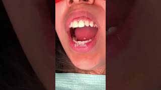 Composite bonding teeth  composite front tooth filling  Dr Yazdan  composite front teeth [upl. by Ttirrem854]