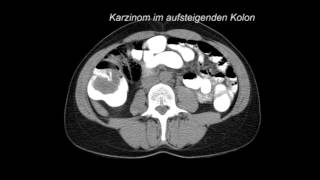 Dr Osterwalder CT Befunde bei Dickdarmkrebs 2014 [upl. by Cilla]