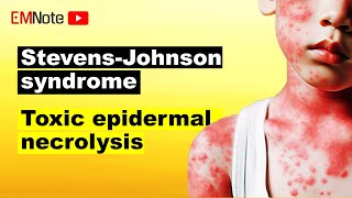 Stevens Johnson Syndrome SJS and TEN [upl. by Anoo]