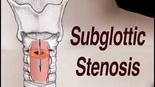 Adult Subglottic Stenosis Treatment [upl. by Rehpotsyrk291]